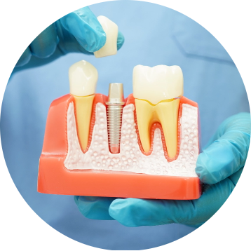 benefits of dental implants in beddington heights