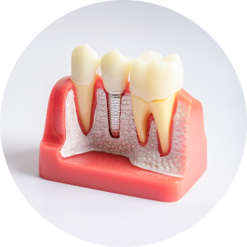 dental implants in beddington heights